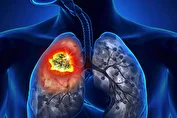 درمان سرطان ریه کشف شد