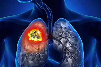 درمان سرطان ریه کشف شد