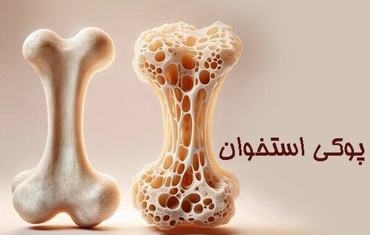 پوکی استخوان یک شبه درمان نمی‌شود