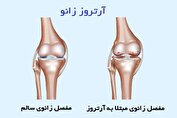 عوامل اصلی بروز آرتروز زانو