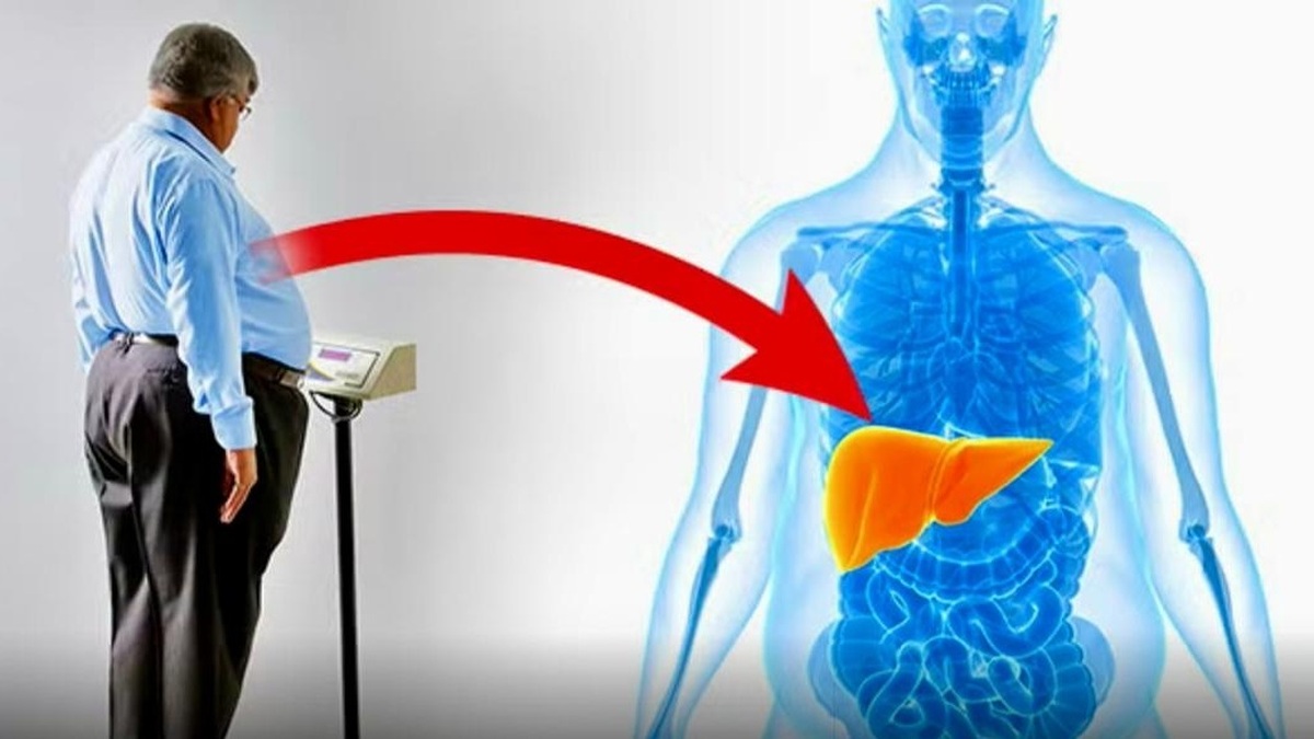 بی‌تحرکی و چاقی؛ جاده یک‌طرفه به سوی سیروز کبدی