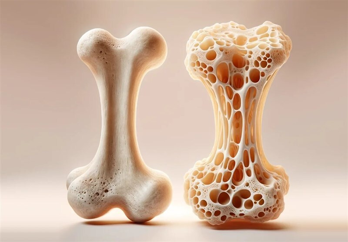 چند نکته ساده برای پیشگیری از پوکی استخوان