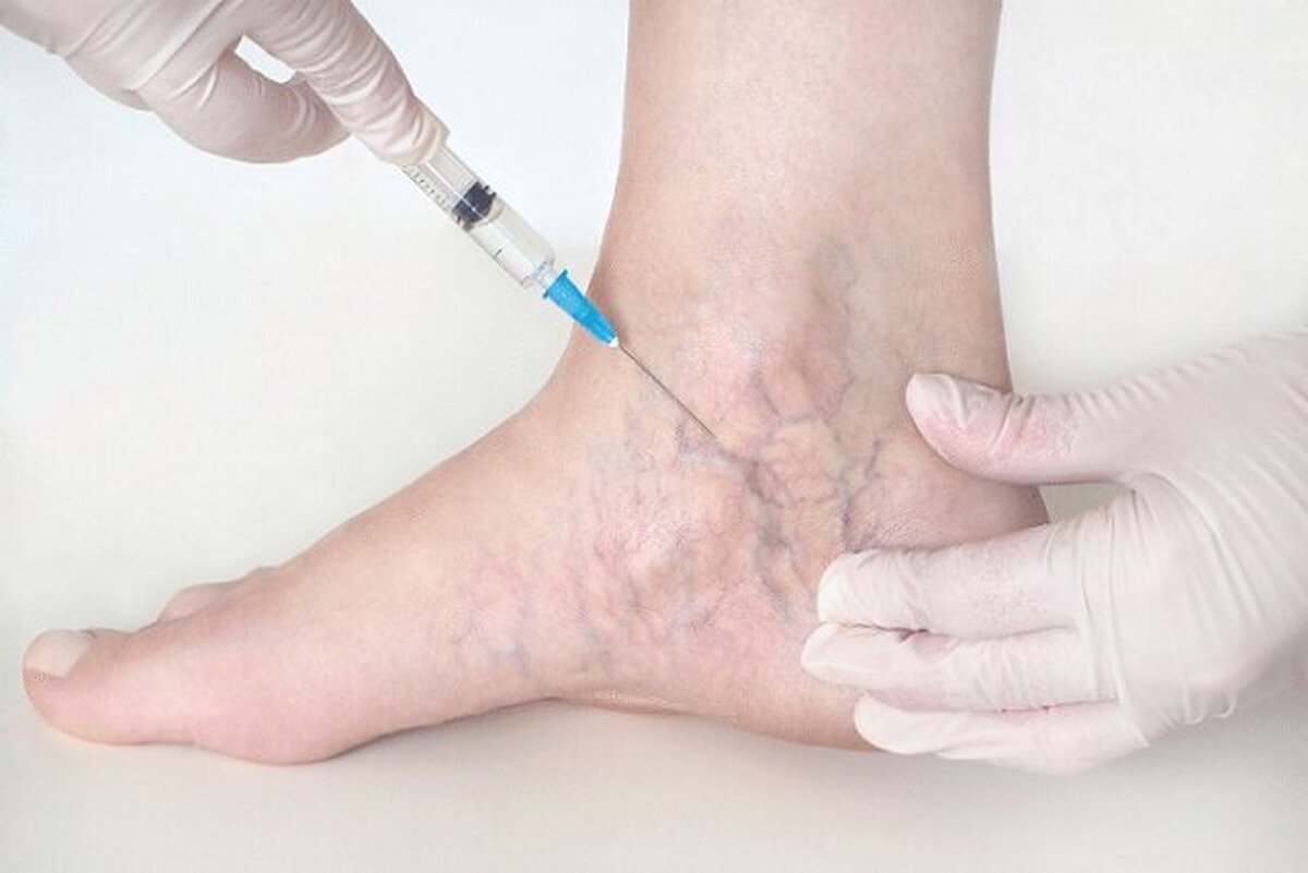 با چند عادت ساده از ابتلا به واریس پیشگیری کنیم