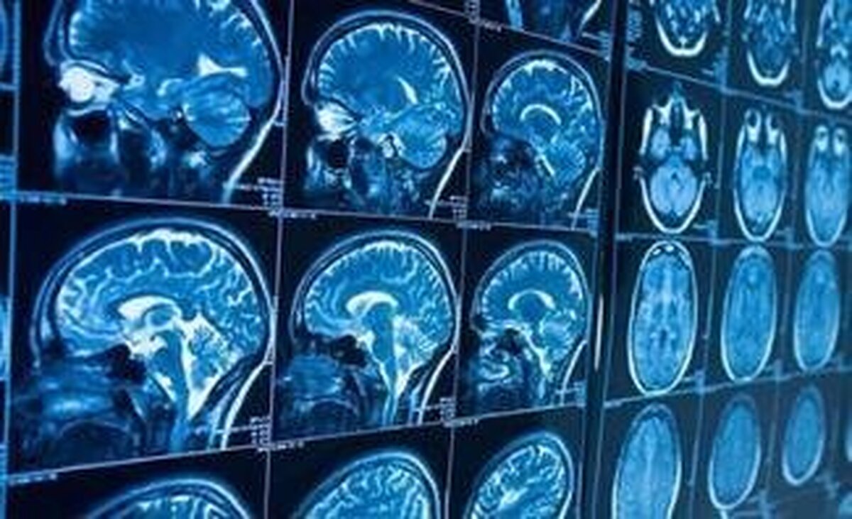 توقف آلزایمر ممکن شد